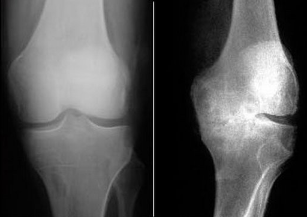 The methods of diagnosis of osteoarthritis