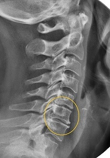 Narrowing of the intervertebral space on radiography. 