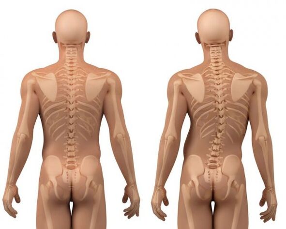 Scoliosis of the spine