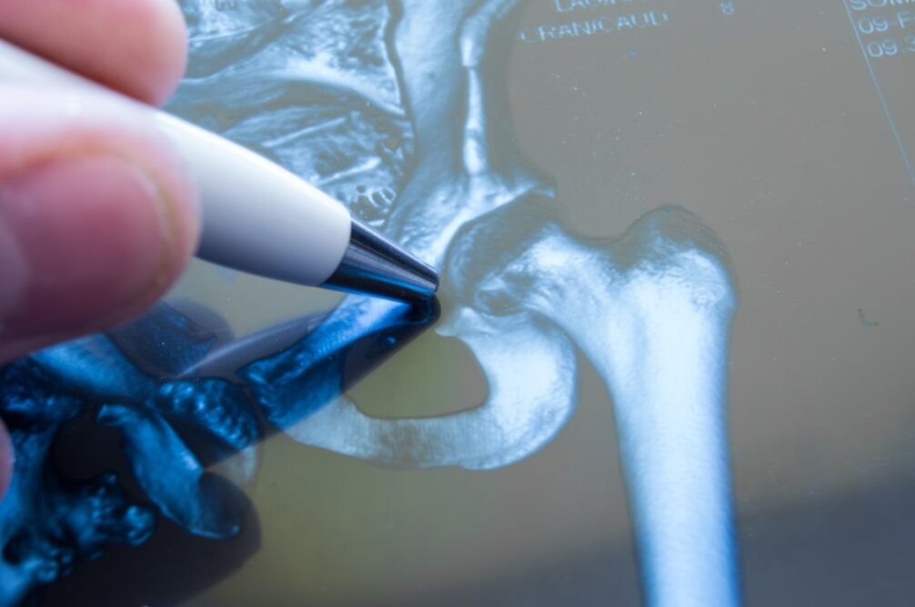 Osteoarthritis of the hip joint on x-ray. 