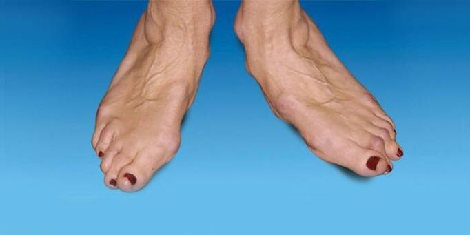 foot deformity with ankle osteoarthritis
