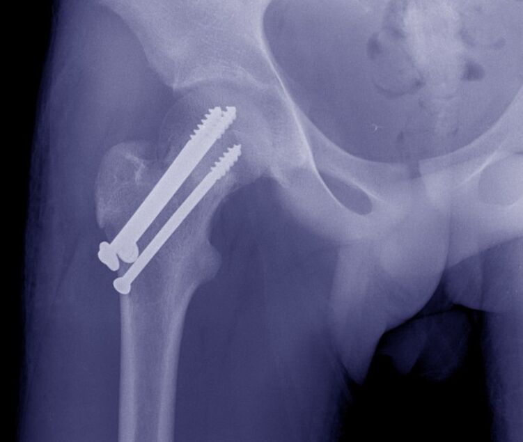X-ray of the hip joint, osteosynthesis of the fracture with internal fixation devices. 