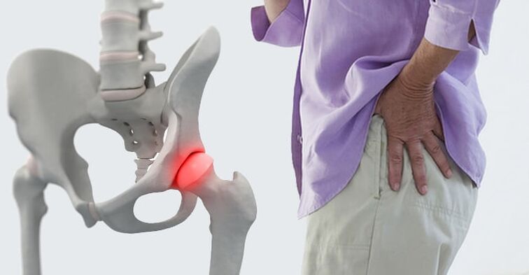 pain in the hip area, a symptom of osteoarthritis of the hip joint