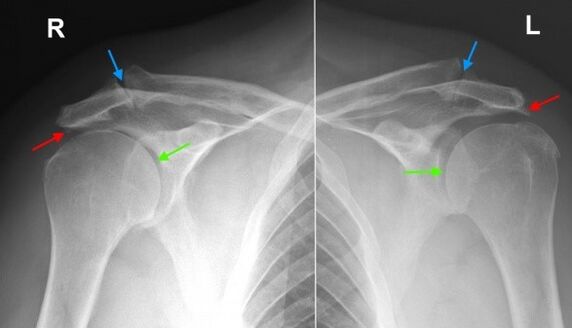 X-ray of the shoulder joints. 