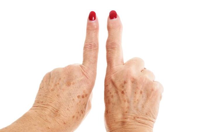 deforming arthrosis in the fingers