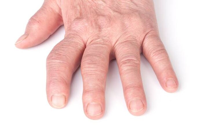 deforming osteoarthritis in the hands