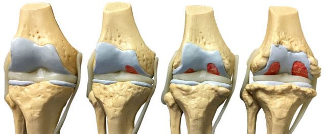 Joint damage at different stages of the development of ankle osteoarthritis. 