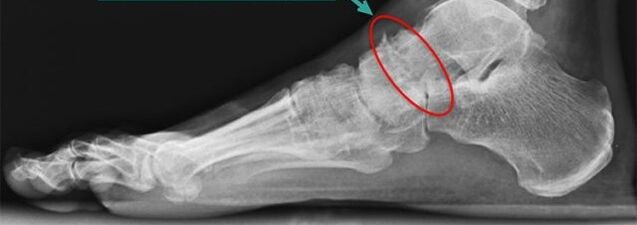 ankle osteoarthritis scan