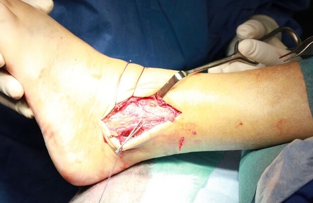 surgery for ankle osteoarthritis