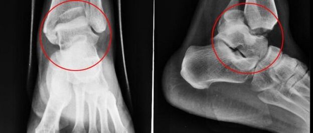 x-ray for ankle osteoarthritis