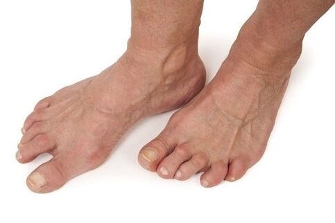 feet affected by osteoarthritis