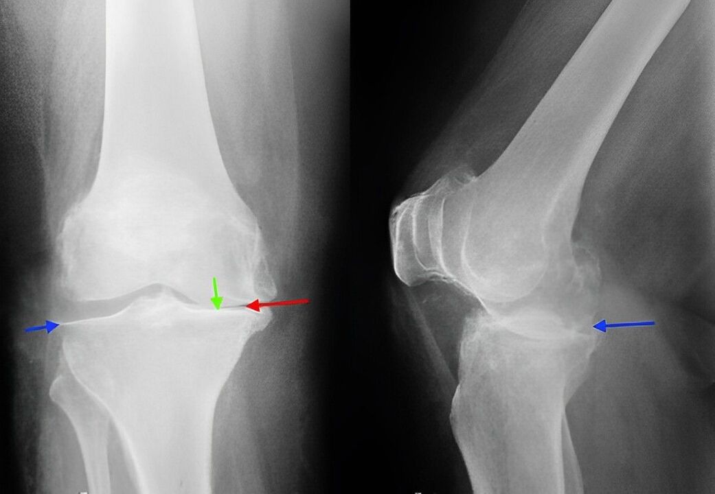 X-ray of osteoarthritis of the knee joint. 