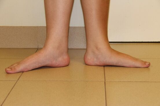 Sometimes the cause of osteoarthritis of the neck is flat feet.