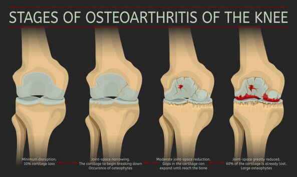 development of joint osteoarthritis