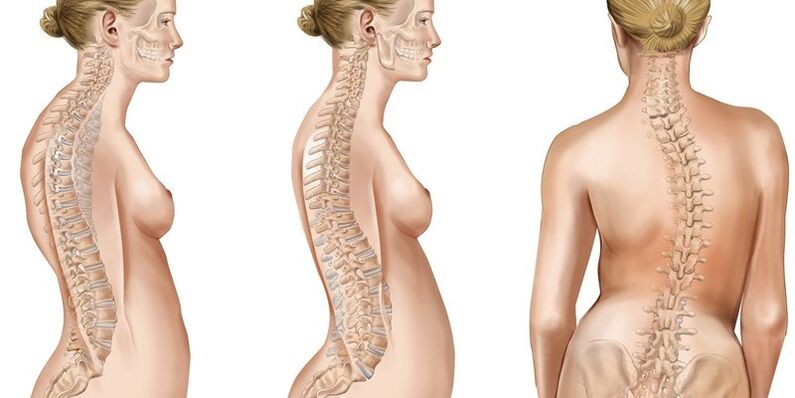 Scoliosis of the thoracic spine causes pain in the shoulder blades.