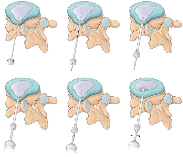 surgery for back pain