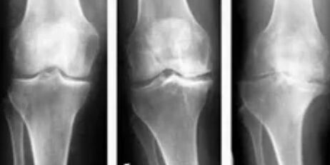 Gonarthrosis 3 degrees