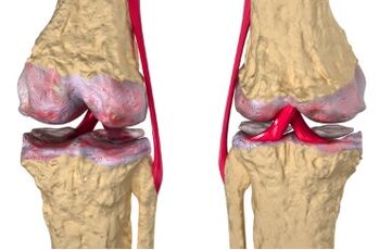 Varicose veins are the cause of the development of gonarthrosis.